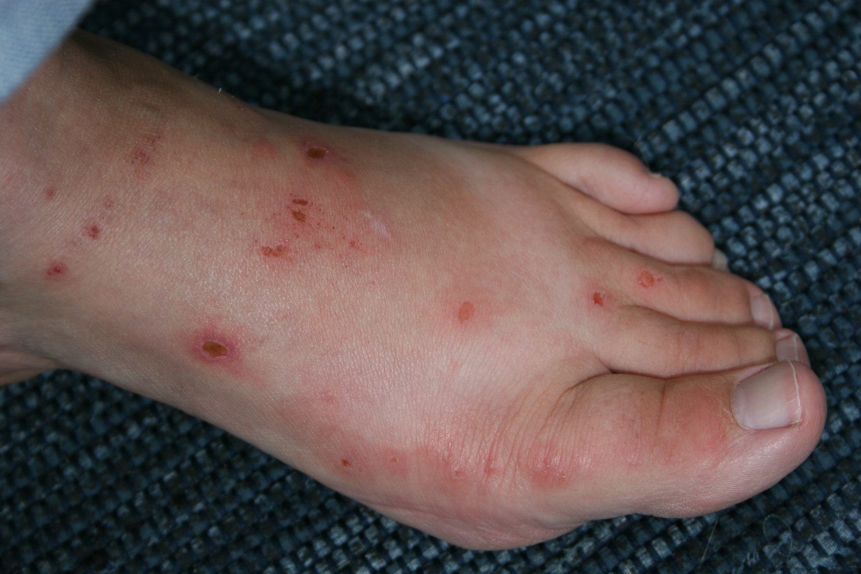 What To Do When You Have Itchy Feet - Foot Vitals